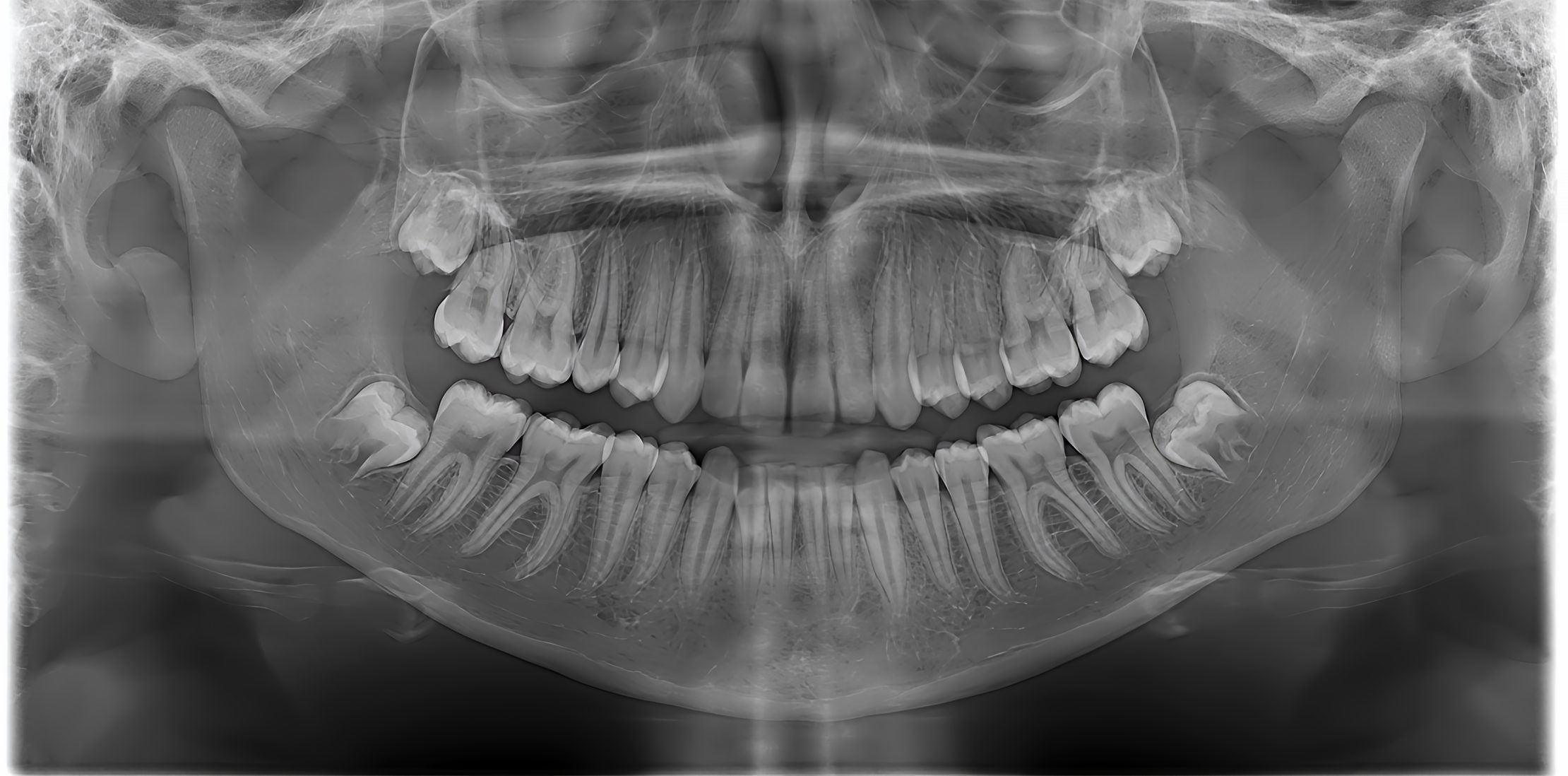 Dental X-Rays